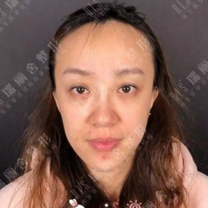 瑞麗舍整形馬君做的全臉自體脂肪填充，不錯呢~