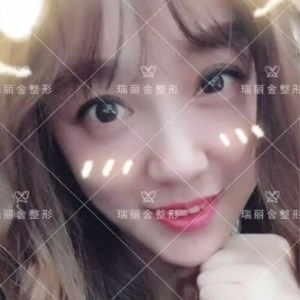 瑞麗舍整形馬君做的全臉自體脂肪填充，不錯呢~