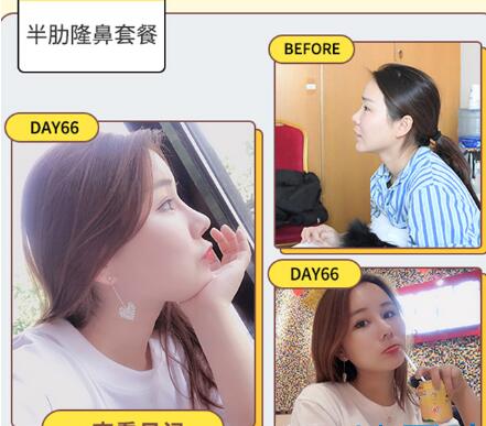 蘇州紫馨趙延峰做的鼻部手術隆鼻案例