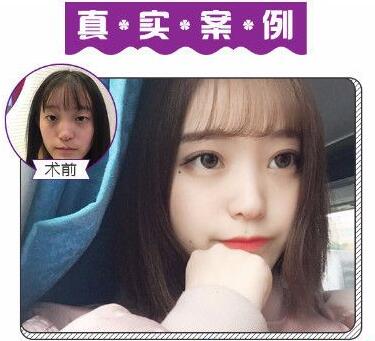 蘇州美萊張亮做的雙眼皮案例