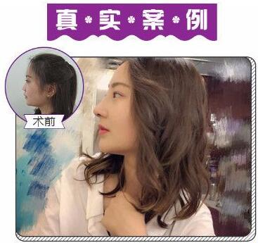 蘇州美萊尹飛做的鼻部手術隆鼻案例