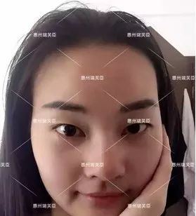 惠州瑞芙臣劉丹虹雙眼皮+開眼角整形日記~