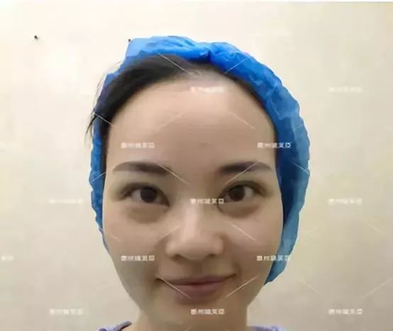 惠州瑞芙臣劉丹虹雙眼皮+開眼角整形日記~