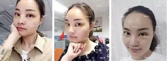 惠州瑞芙臣劉丹虹雙眼皮+開眼角整形日記~