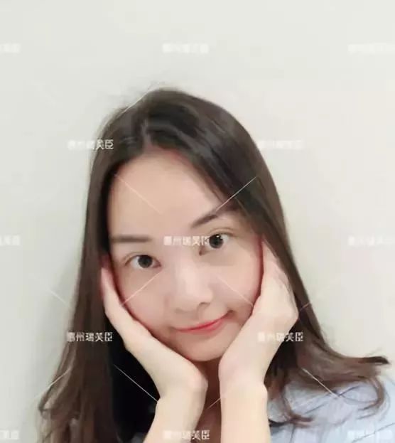 惠州瑞芙臣劉丹虹雙眼皮+開眼角整形日記~