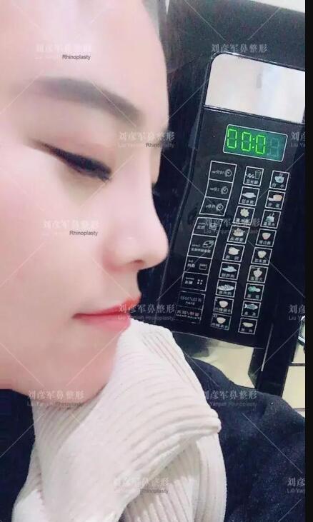 劉彥君隆鼻案例圖恢復(fù)記錄