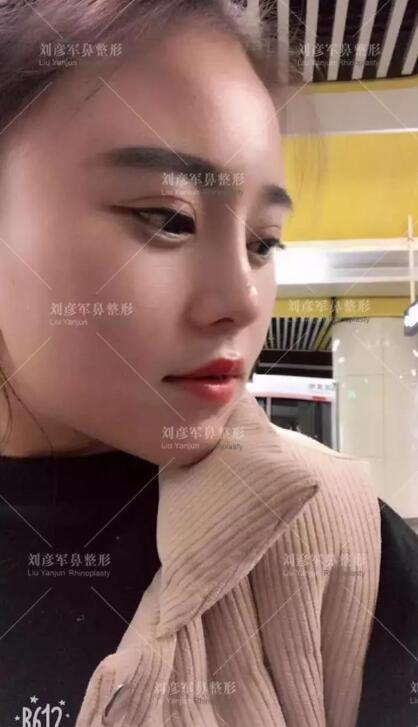 劉彥君隆鼻案例圖恢復(fù)記錄