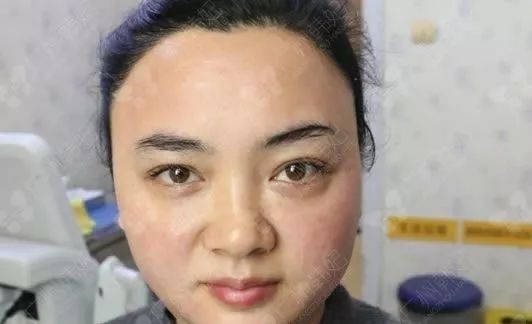 廣州韓妃美版超聲提拉和埋線提升提升日記一則，給你好看~