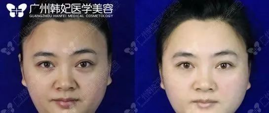 廣州韓妃美版超聲提拉和埋線提升提升日記一則，給你好看~