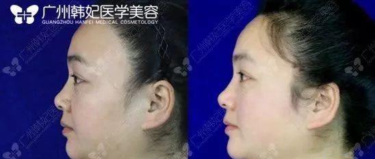 廣州韓妃美版超聲提拉和埋線提升提升日記一則，給你好看~