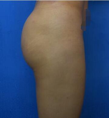 自貢西嬋整形自體脂肪豐臀案例分享~