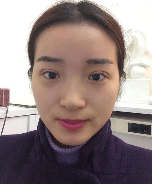 深圳陽光醫(yī)院雙眼皮一個月恢復(fù)圖 日記見證蛻變