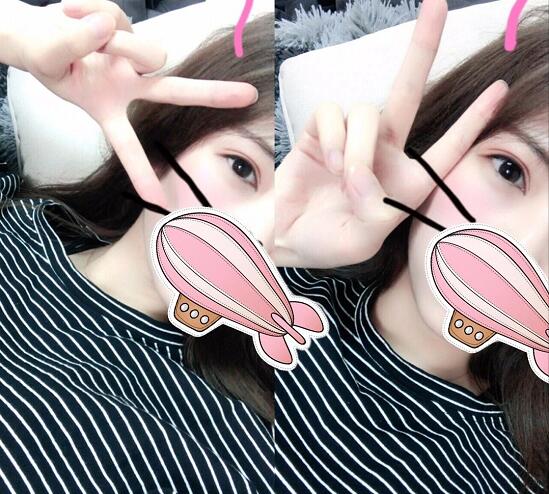 重慶五洲整形醫(yī)院醫(yī)生技術(shù)口碑|雙眼皮案例實(shí)記分享