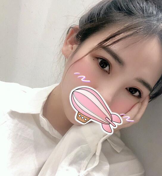 重慶五洲整形醫(yī)院醫(yī)生技術(shù)口碑|雙眼皮案例實(shí)記分享