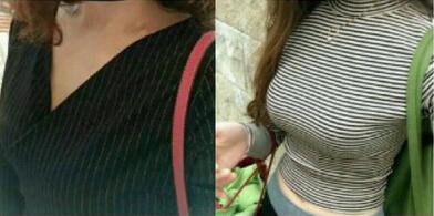 【曼托妙桃400cc水滴形假體隆胸日記——等你等得好辛苦~】