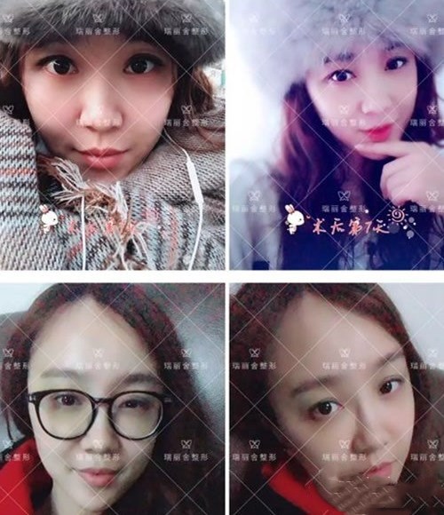 全臉填充手術(shù)第7天恢復(fù)照