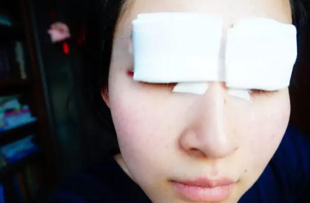 張毅整形醫(yī)生雙眼皮圖分享日記手札