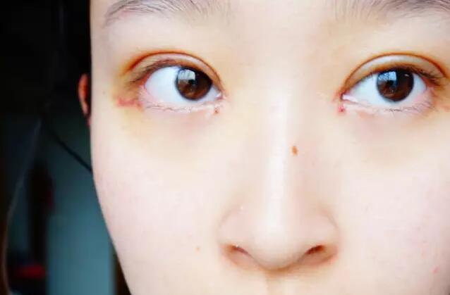 張毅整形醫(yī)生雙眼皮圖分享日記手札