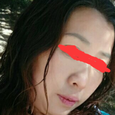 北京邦定張亞昆做的面部提升，果較為不錯(cuò)~