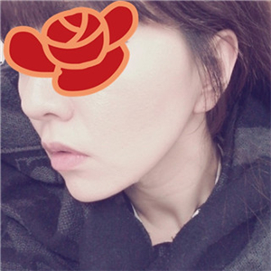 北京南加安棟顯給我做的自體脂肪去法令紋，果很好~