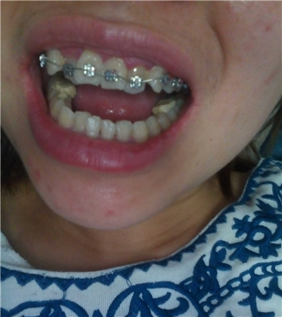 成都圣貝口腔翟永森做的牙齒矯正，分享果照片~