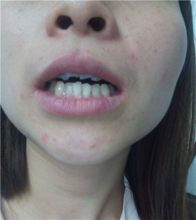 成都圣貝口腔翟永森做的牙齒矯正，分享果照片~