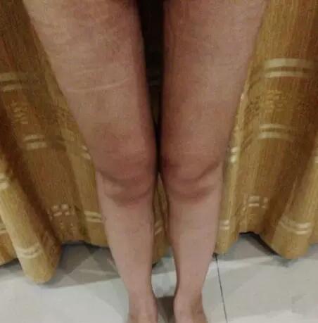 哈醫(yī)大二院整形科徐學(xué)武大腿吸脂術(shù)前后恢復(fù)分享手記