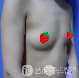 北京伊美爾何禎平假體豐胸照片四個(gè)月恢復(fù)手記