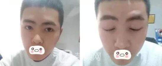 愛思特張姣姣雙眼皮案例照片日記 男生也會做雙眼皮手術哦