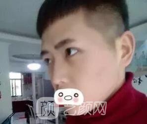 愛思特張姣姣雙眼皮案例照片日記 男生也會做雙眼皮手術哦