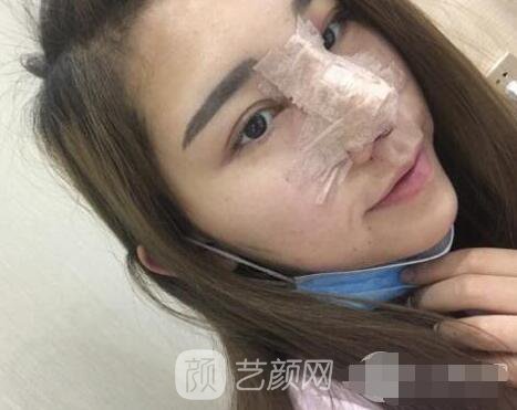 隆鼻案例照片