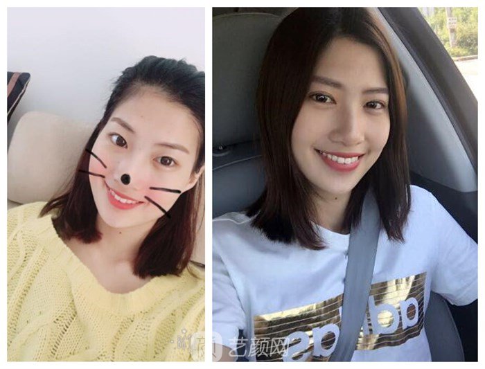 上海伊美爾港華醫(yī)院整形案例圖