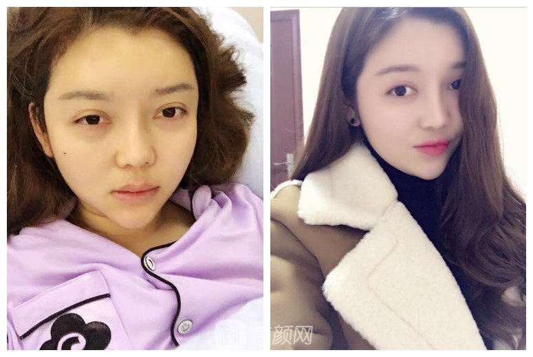 上海伊美爾港華醫(yī)院整形案例圖