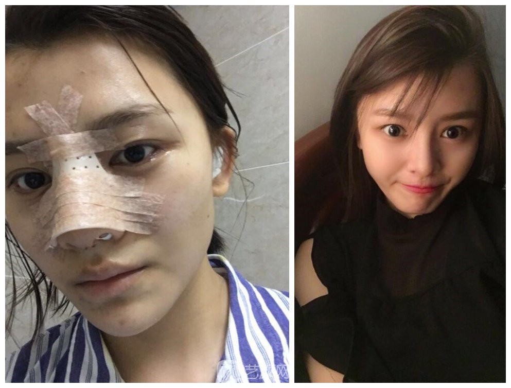 上海伊美爾港華醫(yī)院整形案例圖