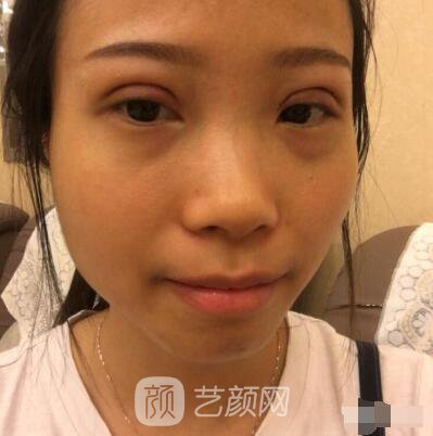 莊璐全切雙眼皮照 全過程恢復(fù)經(jīng)驗(yàn)之談