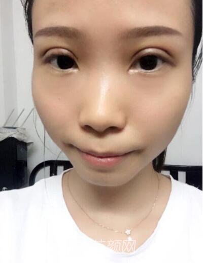 莊璐全切雙眼皮照 全過程恢復(fù)經(jīng)驗(yàn)之談