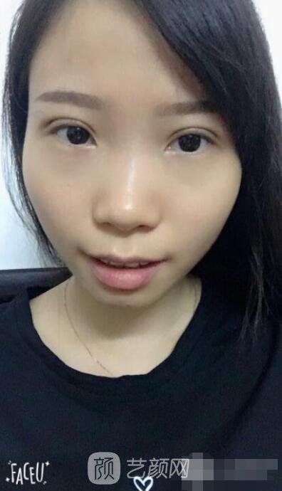 莊璐全切雙眼皮照 全過程恢復(fù)經(jīng)驗(yàn)之談