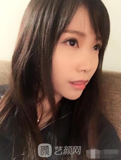 莊璐全切雙眼皮照 全過程恢復(fù)經(jīng)驗(yàn)之談