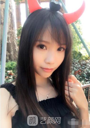 莊璐全切雙眼皮照 全過程恢復(fù)經(jīng)驗(yàn)之談