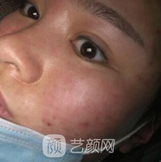 福州比華利林秋蓉激光祛痘圖 滿臉痘痘到光滑肌膚