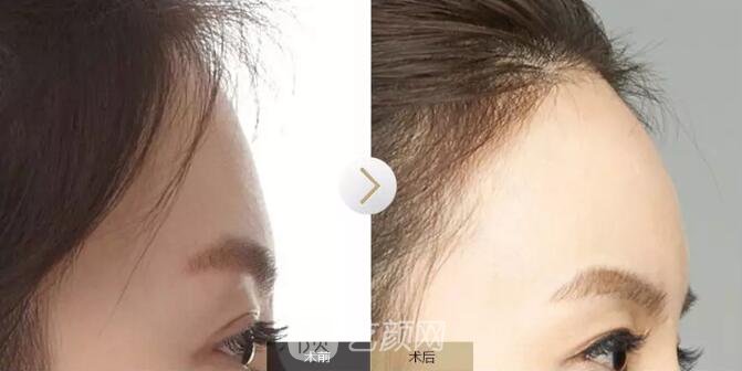 重慶當(dāng)代整形醫(yī)院自體脂肪填充照真人案例