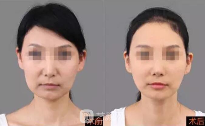 重慶當(dāng)代整形醫(yī)院自體脂肪填充照真人案例
