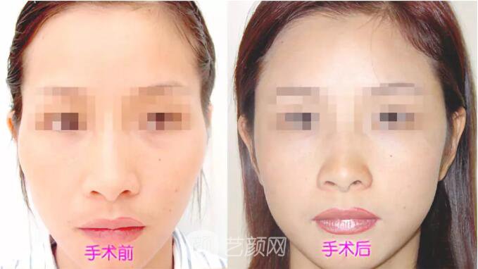 重慶當(dāng)代整形醫(yī)院自體脂肪填充照真人案例