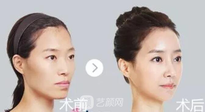 重慶當(dāng)代整形醫(yī)院自體脂肪填充照真人案例