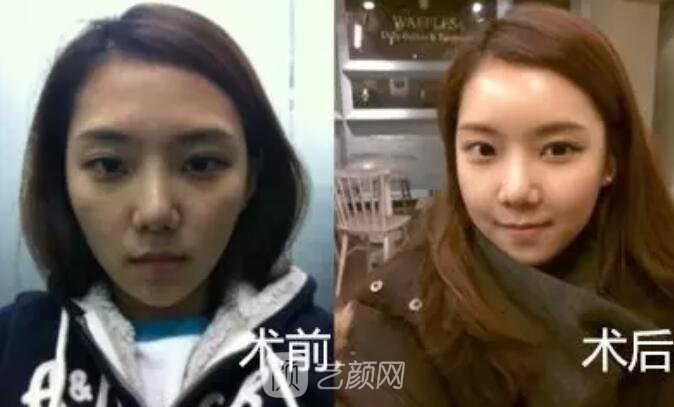 重慶當(dāng)代整形醫(yī)院自體脂肪填充照真人案例