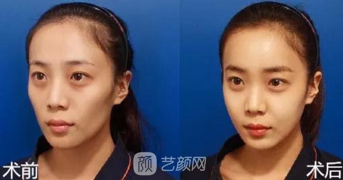 重慶當(dāng)代整形醫(yī)院自體脂肪填充照真人案例