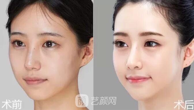 重慶當(dāng)代整形醫(yī)院自體脂肪填充照真人案例