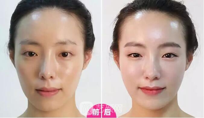 重慶當(dāng)代整形醫(yī)院自體脂肪填充照真人案例