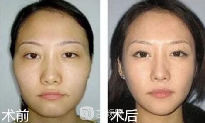 重慶當(dāng)代整形醫(yī)院自體脂肪填充照真人案例