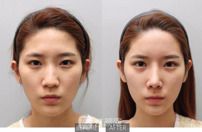 重慶當(dāng)代整形醫(yī)院自體脂肪填充照真人案例